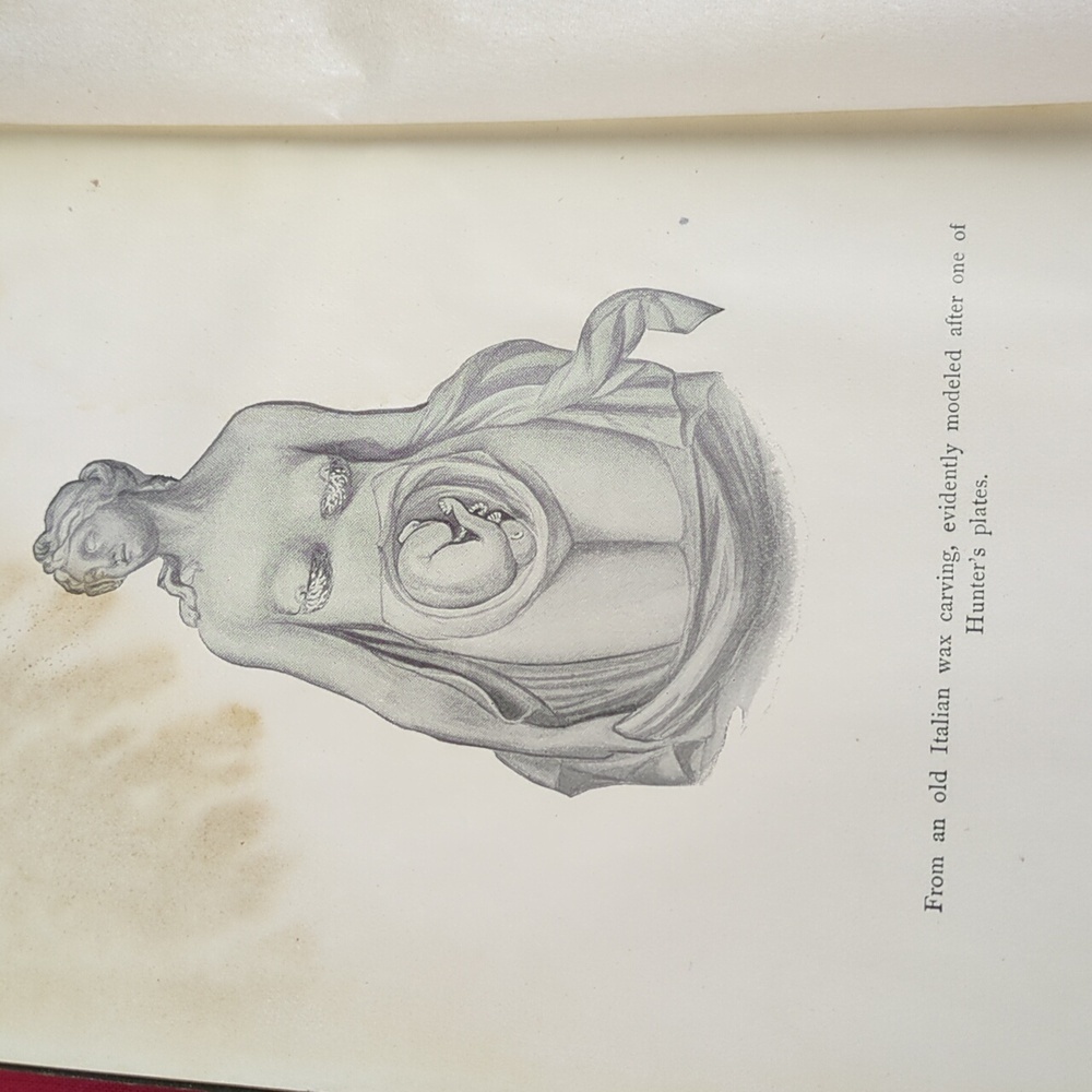 Antique 1915 Obstetrics For Nurses Book - Picture 8 of 13